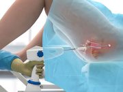 Лазерное лечение опущения стенок влагалища: показания к проведению и преимущества процедуры