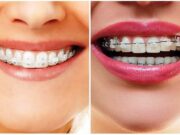 Какие брекеты лучше: керамические или металлические?