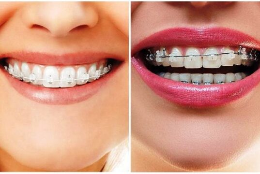 Какие брекеты лучше: керамические или металлические?