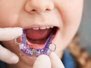 Какие проблемы исправляет детский ортодонт?