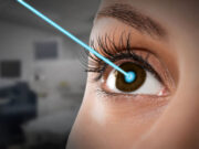 Персонализированная коррекция зрения по методике Супер Ласик