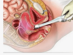 Трансвагинальное выход: что это такое и зачем оно нужно