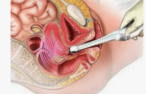 Трансвагинальное выход: что это такое и зачем оно нужно