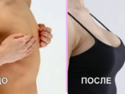 Маммопластика: Трансформация и уверенность в себе