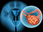 Рак яичников