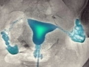 Когда нужно делать эхосальпингоскопию