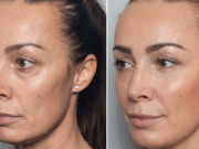 Что лучше: липофилинг или филлеры