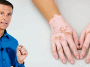 Современные методы лечения витилиго