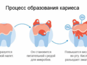 Лечение кариеса зубов: как справиться с проблемой эффективно