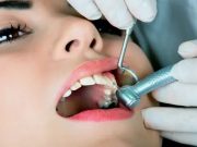 Лечение кариеса: современные подходы, которые вернут зубам здоровье