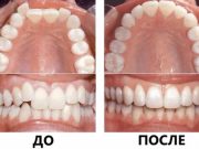 Какие методы лечения позволяют исправить прикус за короткий срок?