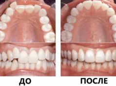 Какие методы лечения позволяют исправить прикус за короткий срок?