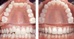 Какие методы лечения позволяют исправить прикус за короткий срок?