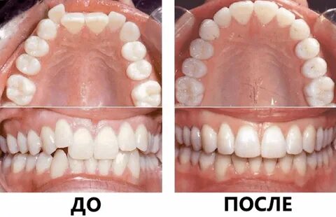Какие методы лечения позволяют исправить прикус за короткий срок?