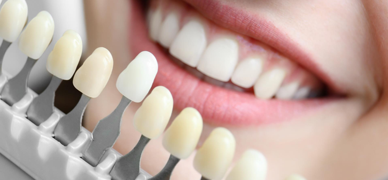 Что такое винир и для чего он служит?