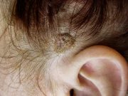 Кератомы: причины возникновения, виды и методы лечения