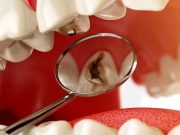 Современные методы лечения кариеса