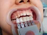 Виды виниров и их отличия